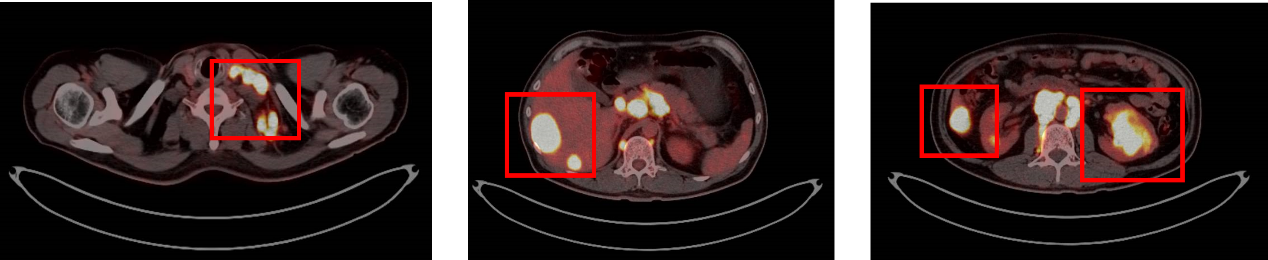 图2. 基线PET-CT.png