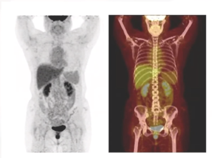 图4. 治疗6周期后PET-CT.png