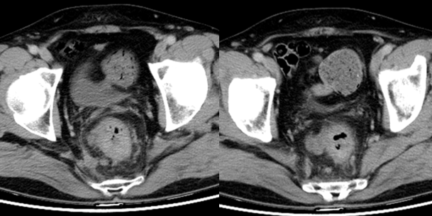 图2. 直肠CT检查(2023年7月5日).png 图2. 直肠CT检查(2023年7月5日).png