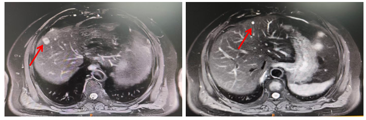 图1. 腹部MRI检查(2019年3月11日).png 图1. 腹部MRI检查(2019年3月11日).png