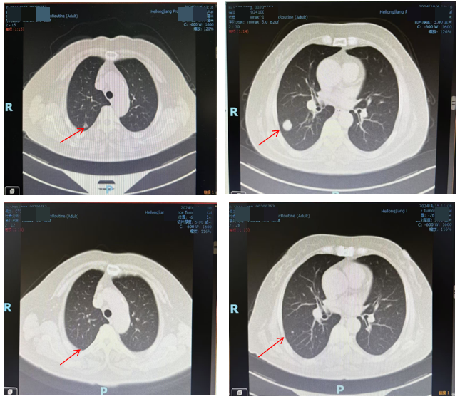 图3. 胸部CT检查(上:2024年10月6日;下:2024年4月15日).png 图3. 胸部CT检查(上:2024年10月6日;下:2024年4月15日).png