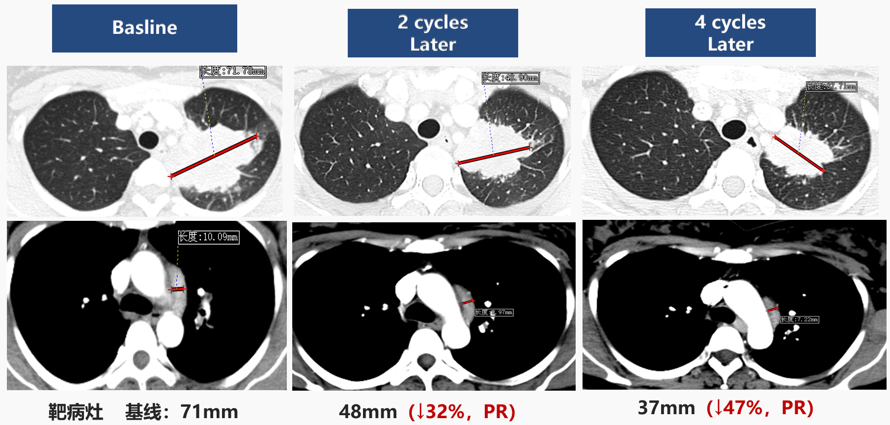 图3 新辅助治疗前后CT影像.png 图3 新辅助治疗前后CT影像.png