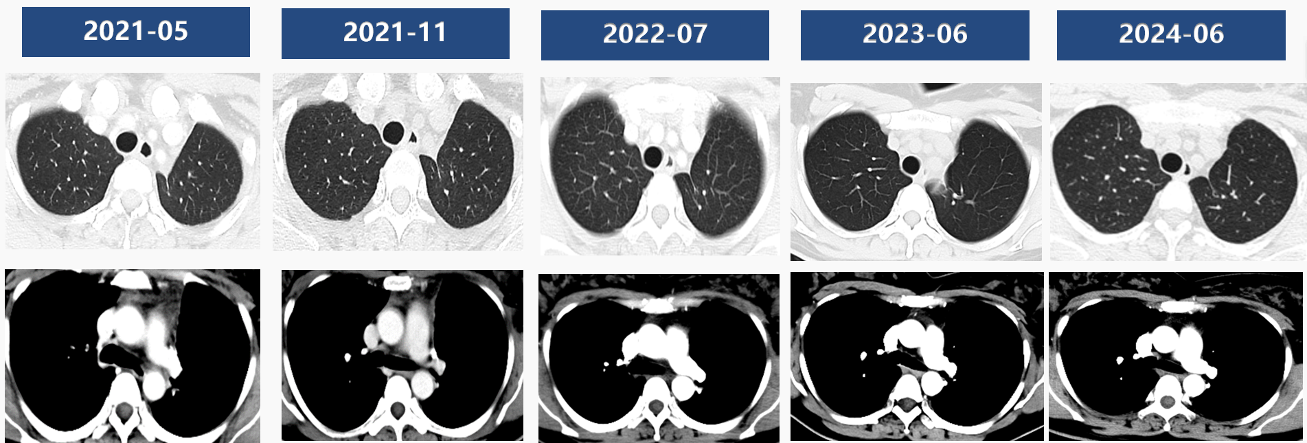 图4 术后3年CT影像.png 图4 术后3年CT影像.png