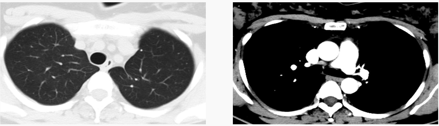 图5 术后4年CT影像.png 图5 术后4年CT影像.png