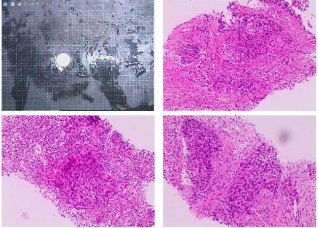 图2 肺穿刺活检病理.png 图2 肺穿刺活检病理.png