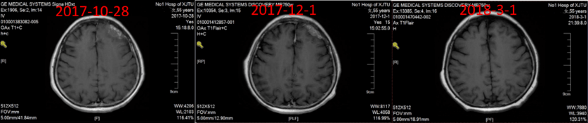 实战演练|文献梳理及病例分享,手把手助力乳腺癌骨转移临床实操8767.png 实战演练|文献梳理及病例分享,手把手助力乳腺癌骨转移临床实操8767.png
