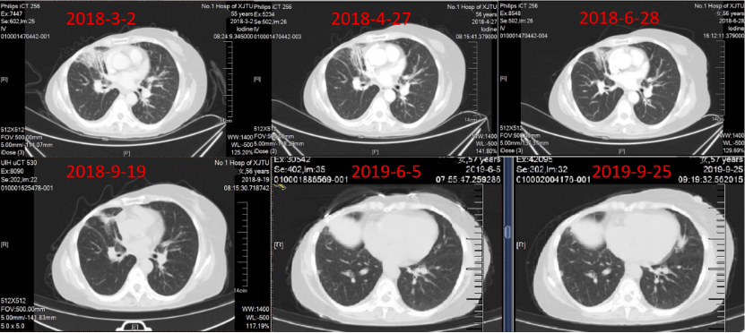实战演练|文献梳理及病例分享,手把手助力乳腺癌骨转移临床实操8629.png 实战演练|文献梳理及病例分享,手把手助力乳腺癌骨转移临床实操8629.png