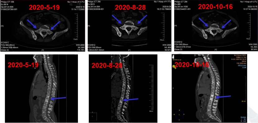 实战演练|文献梳理及病例分享,手把手助力乳腺癌骨转移临床实操11195.png 实战演练|文献梳理及病例分享,手把手助力乳腺癌骨转移临床实操11195.png
