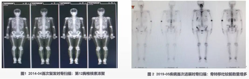 实战演练|文献梳理及病例分享,手把手助力乳腺癌骨转移临床实操13251.png