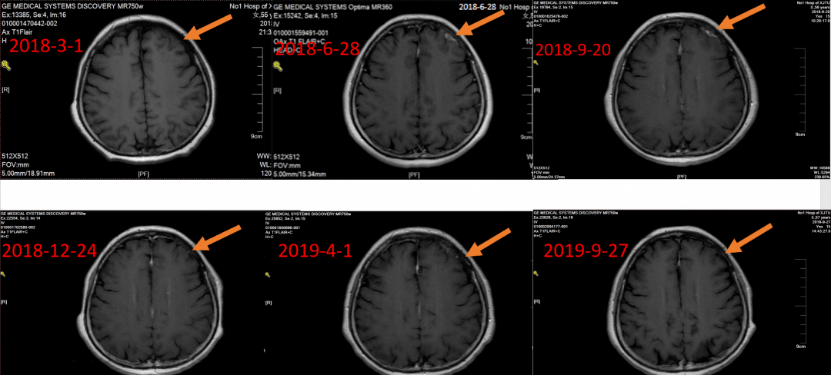 实战演练|文献梳理及病例分享,手把手助力乳腺癌骨转移临床实操8903.png 实战演练|文献梳理及病例分享,手把手助力乳腺癌骨转移临床实操8903.png