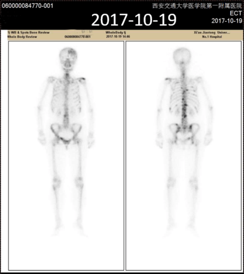 实战演练|文献梳理及病例分享,手把手助力乳腺癌骨转移临床实操7730.png 实战演练|文献梳理及病例分享,手把手助力乳腺癌骨转移临床实操7730.png