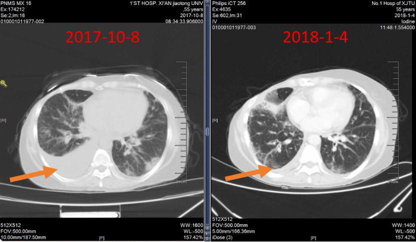 实战演练|文献梳理及病例分享,手把手助力乳腺癌骨转移临床实操8493.png 实战演练|文献梳理及病例分享,手把手助力乳腺癌骨转移临床实操8493.png