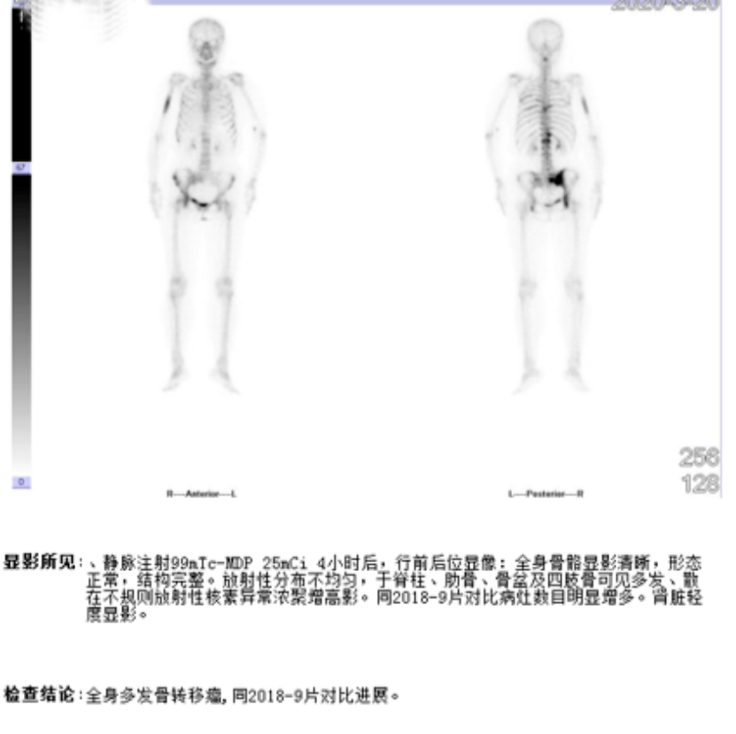 实战演练|文献梳理及病例分享,手把手助力乳腺癌骨转移临床实操10910.png 实战演练|文献梳理及病例分享,手把手助力乳腺癌骨转移临床实操10910.png