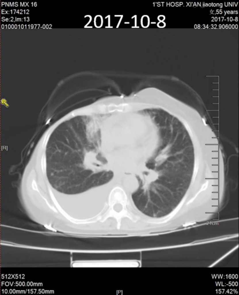 实战演练|文献梳理及病例分享,手把手助力乳腺癌骨转移临床实操7557.png 实战演练|文献梳理及病例分享,手把手助力乳腺癌骨转移临床实操7557.png