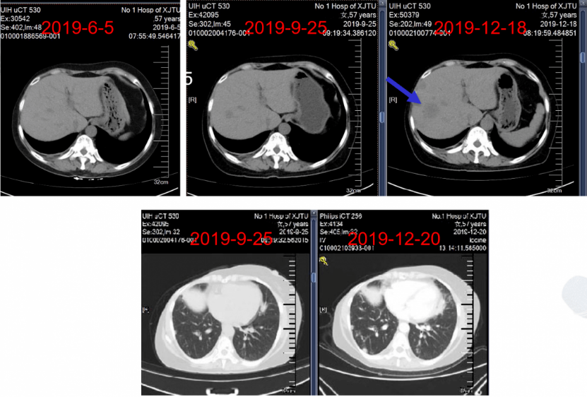 实战演练|文献梳理及病例分享,手把手助力乳腺癌骨转移临床实操9079.png 实战演练|文献梳理及病例分享,手把手助力乳腺癌骨转移临床实操9079.png
