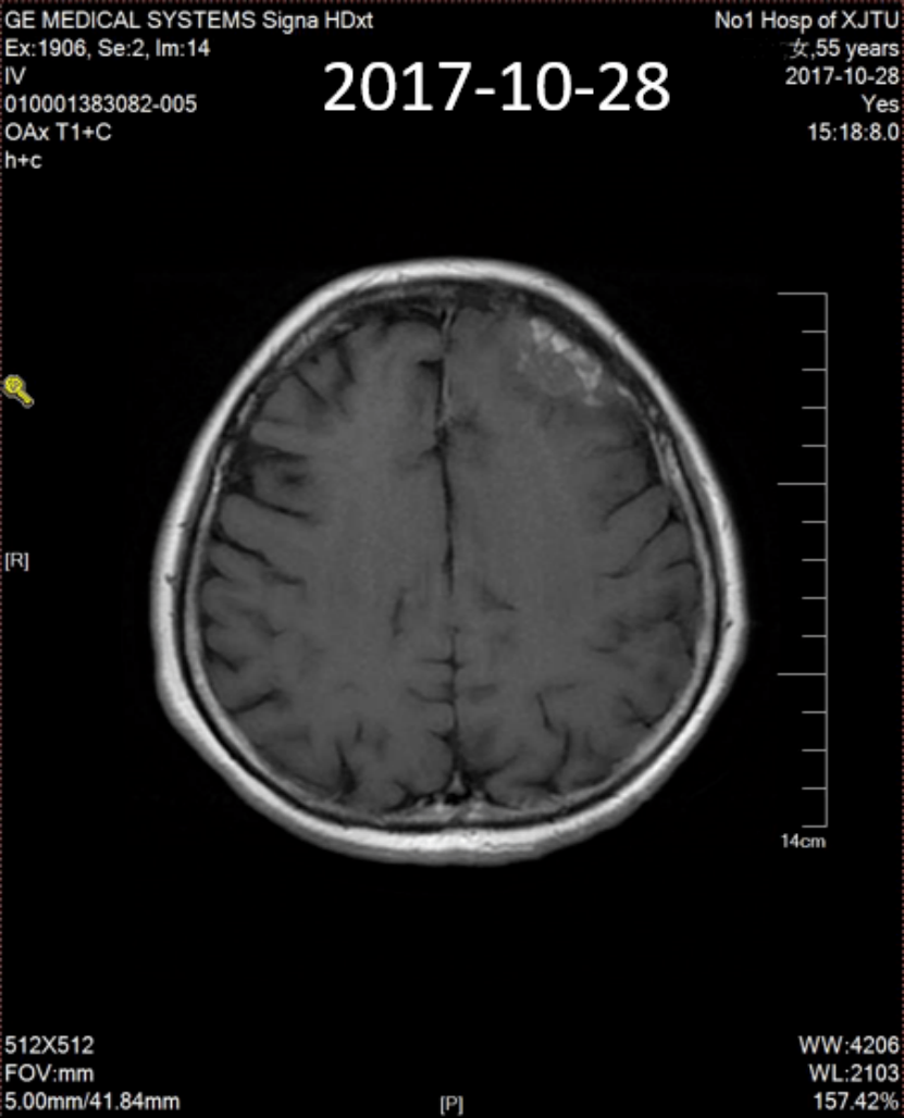 实战演练|文献梳理及病例分享,手把手助力乳腺癌骨转移临床实操7936.png 实战演练|文献梳理及病例分享,手把手助力乳腺癌骨转移临床实操7936.png