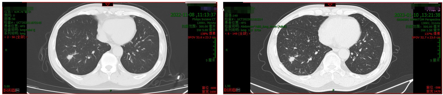 肺部CT（左：2022年11月8日；右：2023年1月10日）.png