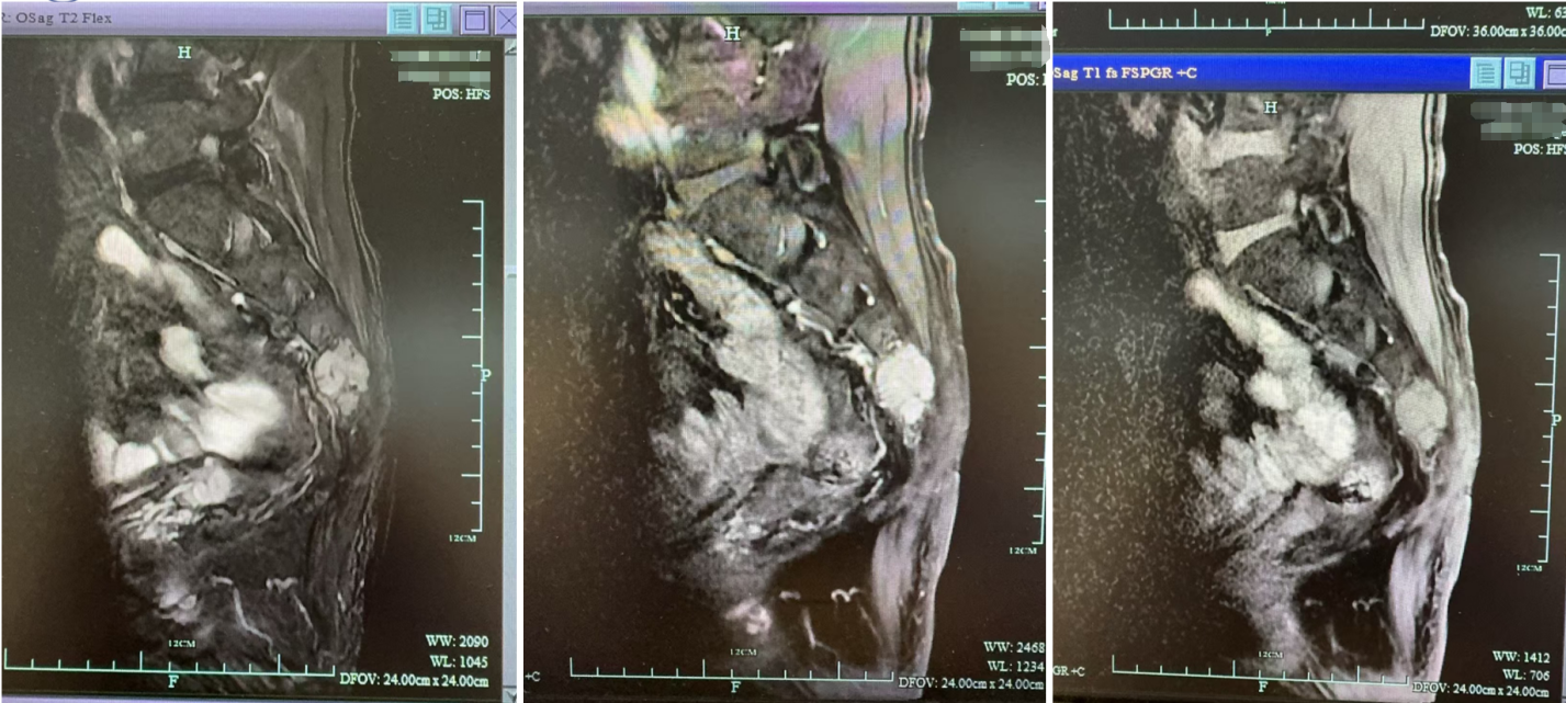骶尾椎MRI（2023年5月15日 ）.png