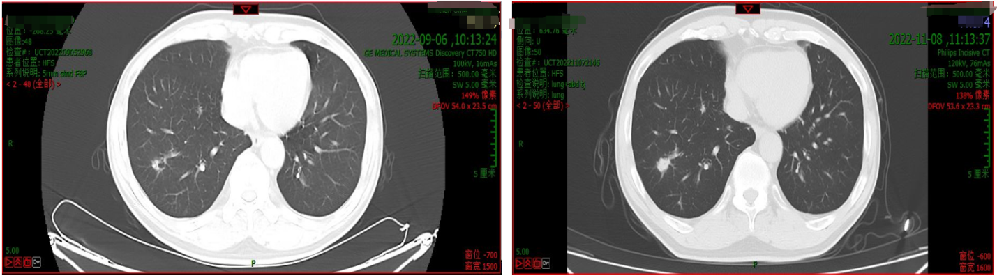 肺部CT（左：2022年9月6日；右：2022年11月8日）.png
