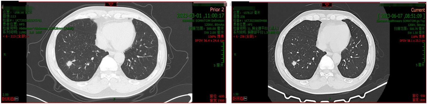 肺部CT（左：2023年3月1日；右：2023年6月7日）.png