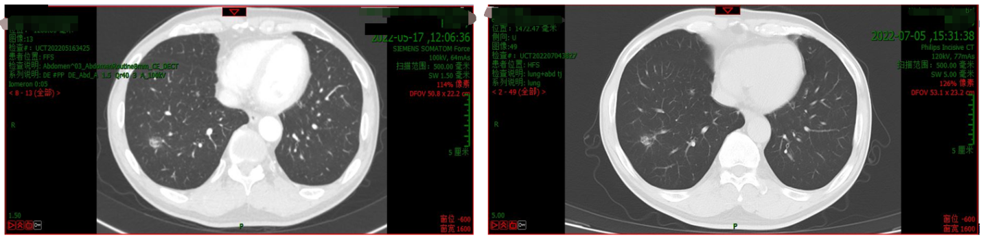 肺部CT（左：2022年5月17日；右：2022年7月5日）.png