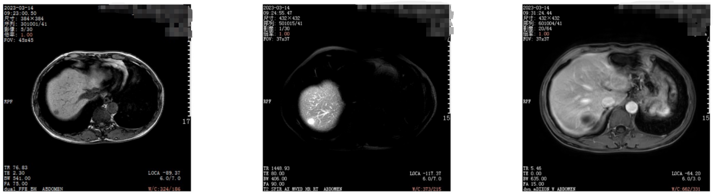 上腹部MRI（2023年3月14日 ）.png