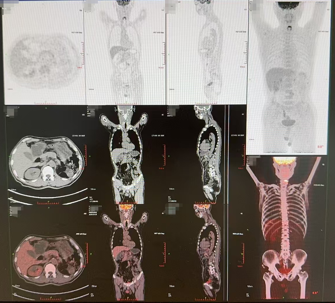 PET-CT（2023年3月21日）.png