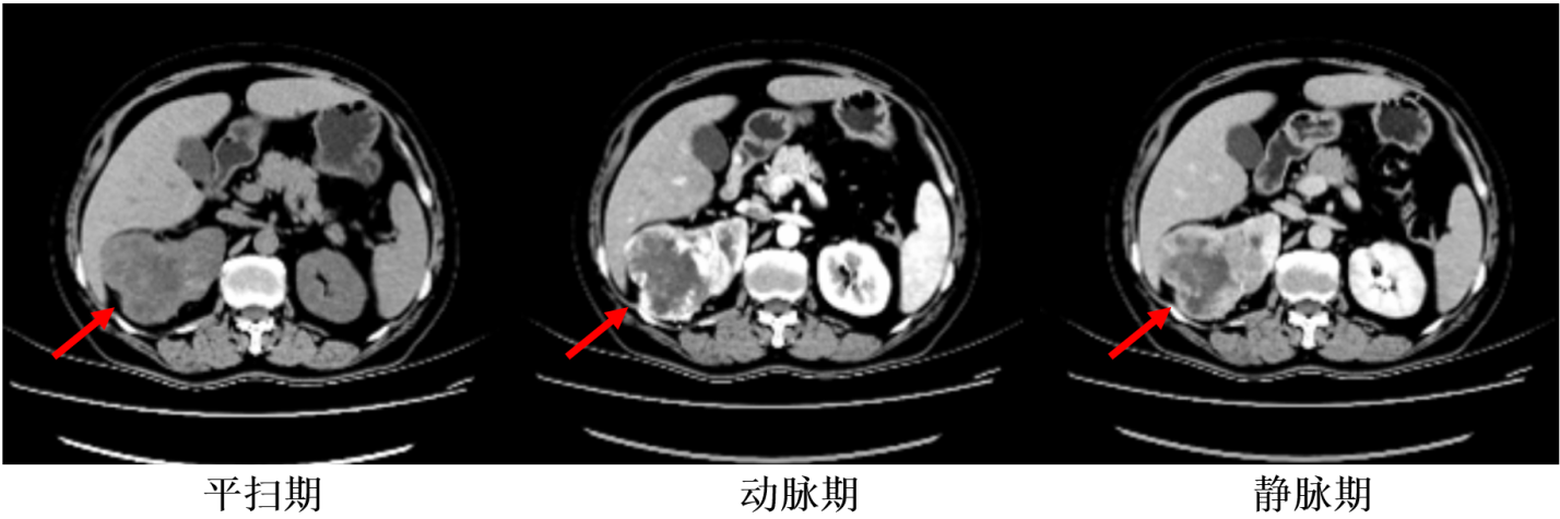 肾脏强化CT基线（2020年7月25日）.png