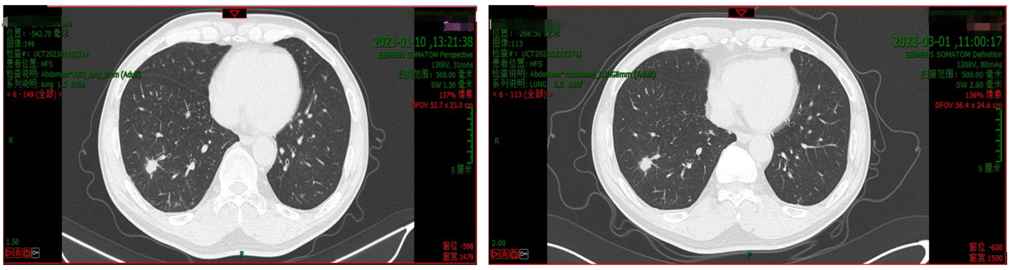 肺部CT（左：2023年1月10日；右：2023年3月1日）.png