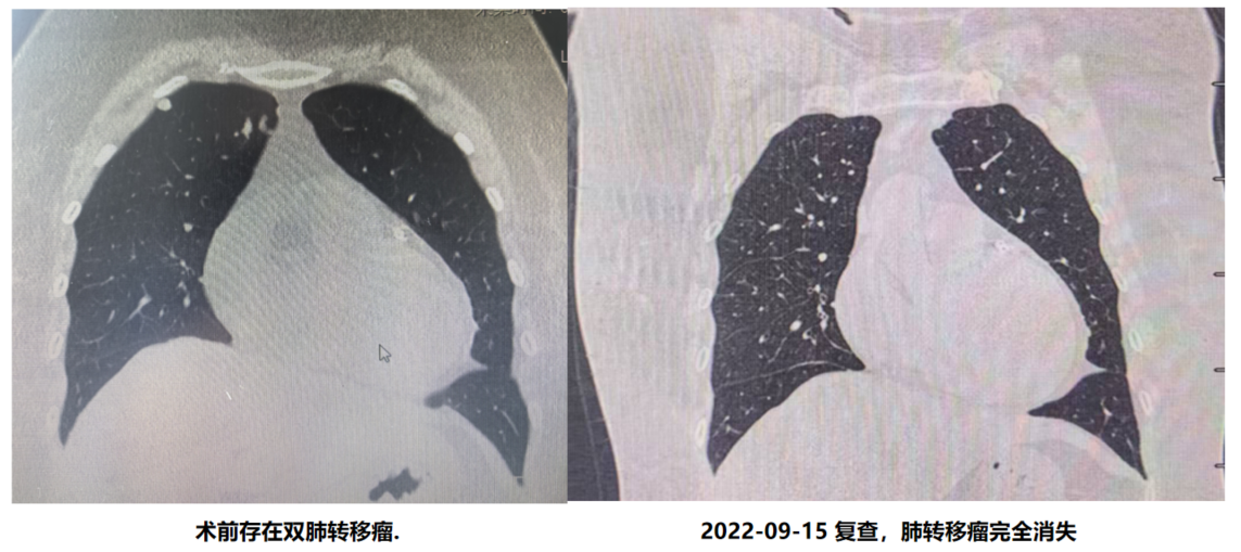 肺部CT（2022年9月15日）.png