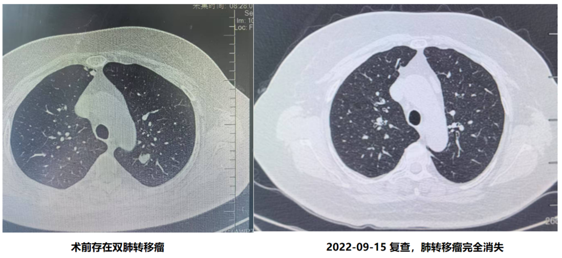 肺部CT（2022年09月15日 ）.png