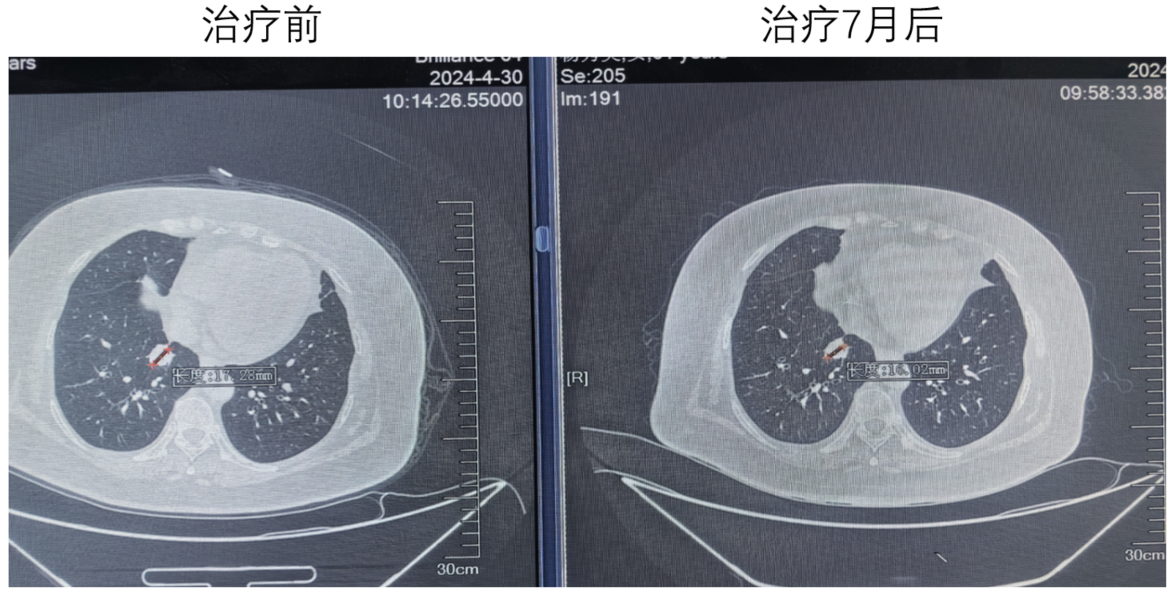 肺部CT（左：2024年4月30日；右：2024年11月 ）.png