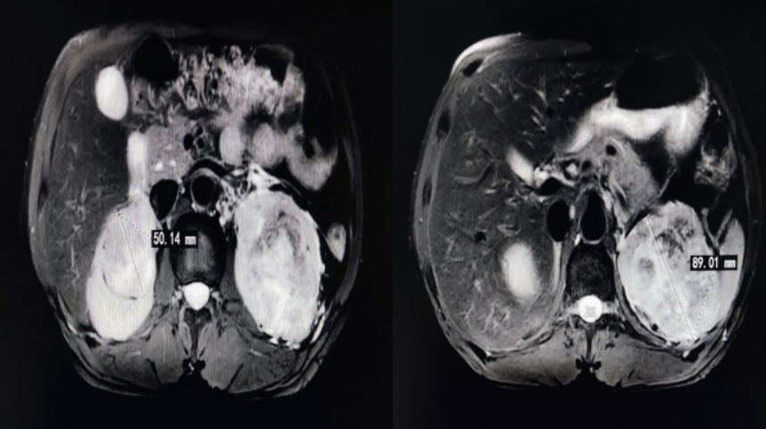 肾脏MRI（2024年1月2日）.png