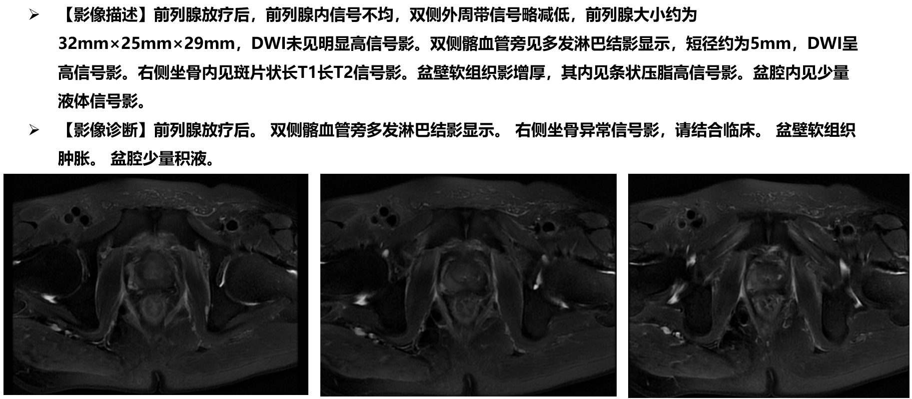 2024.05.10复查前列腺核磁.png