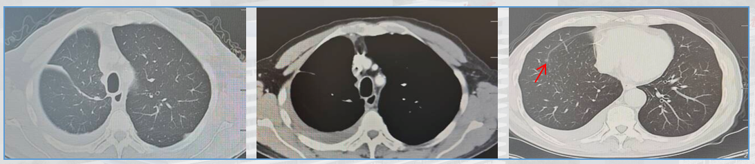 图7 2025.5.08术后CT影像.png