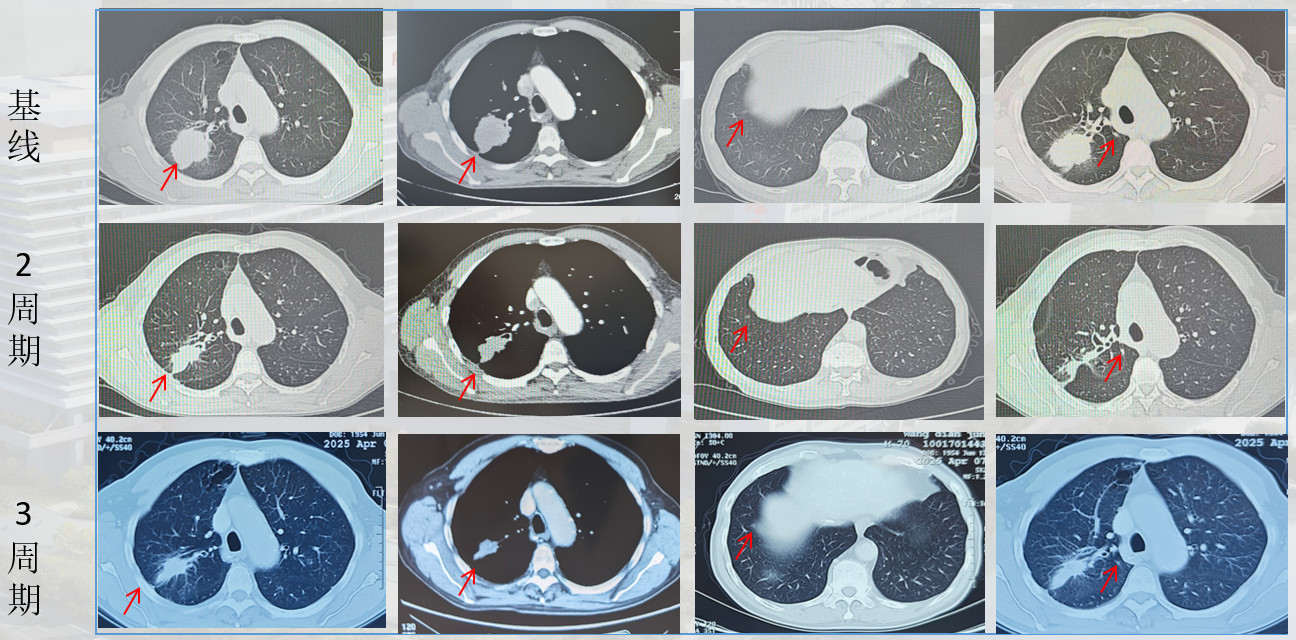图5 新辅助治疗期间CT影像.png