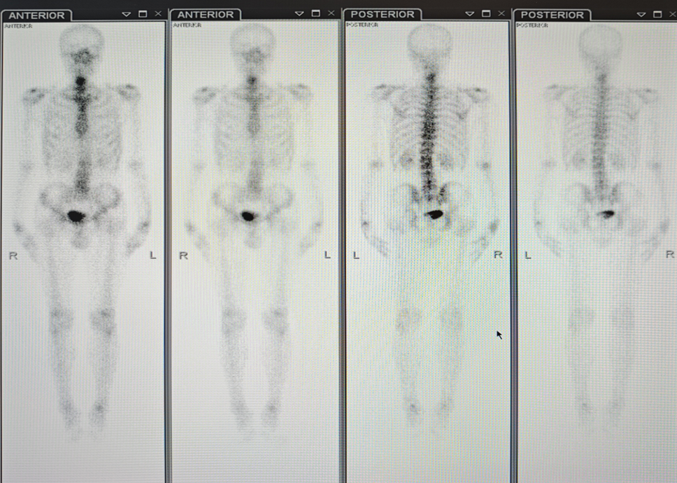 图4. 骨扫描影像.png