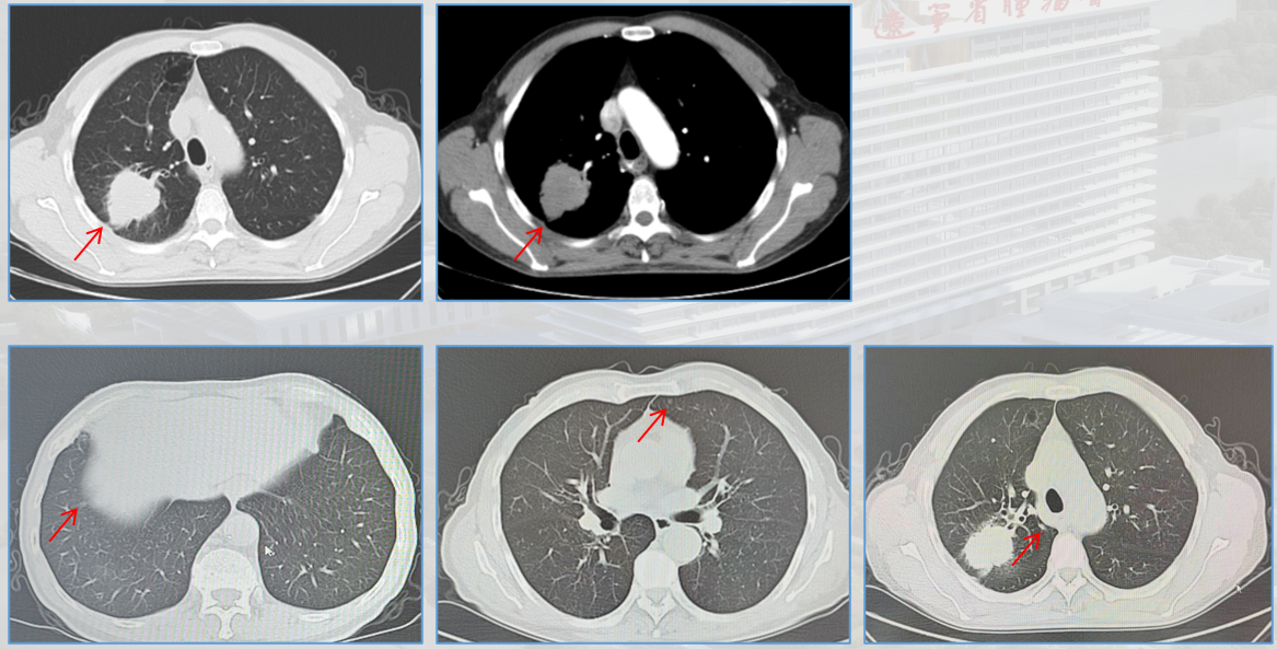 图1 胸部+上腹部增强CT影像.png