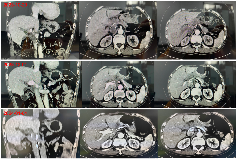 术后约4个月、5个月、6个月（从上往下）上腹部CT影像.png