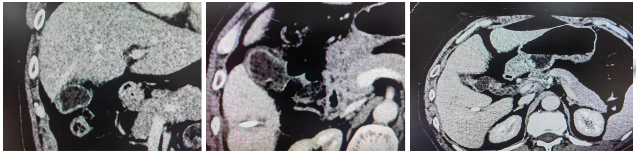 2023-05-15上腹部CT影像.png