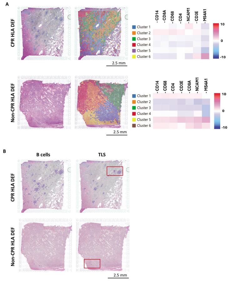 图3 空间转录组分析显示新辅助ChIO后，达到CPR的HLA-DEF肿瘤中存在强烈的免疫反应和TLS.png