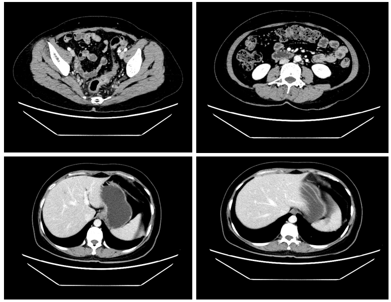 图1. “FOLFIRIOX+贝伐单抗”治疗4周期后腹部CT.png 图1. “FOLFIRIOX+贝伐单抗”治疗4周期后腹部CT.png
