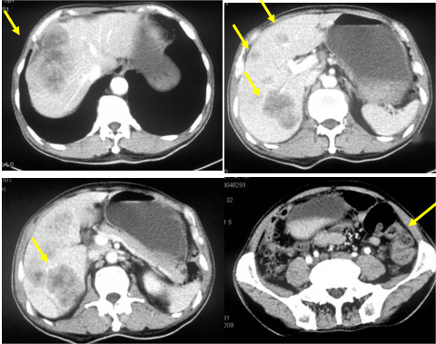 图2. 腹部CT检查(2021年8月4日).png 图2. 腹部CT检查(2021年8月4日).png