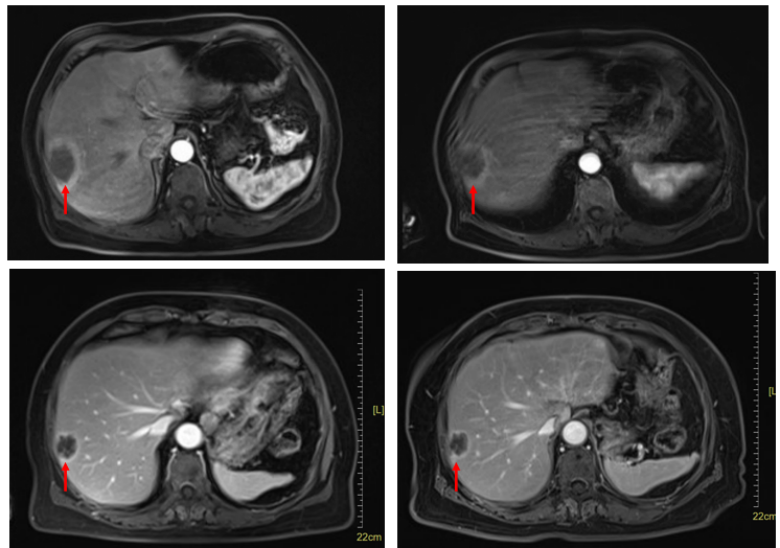 图3. 腹部CT检查(左上:2024.05;右上:2024.07;左下:2024.09;右下:2024.11).png 图3. 腹部CT检查(左上:2024.05;右上:2024.07;左下:2024.09;右下:2024.11).png
