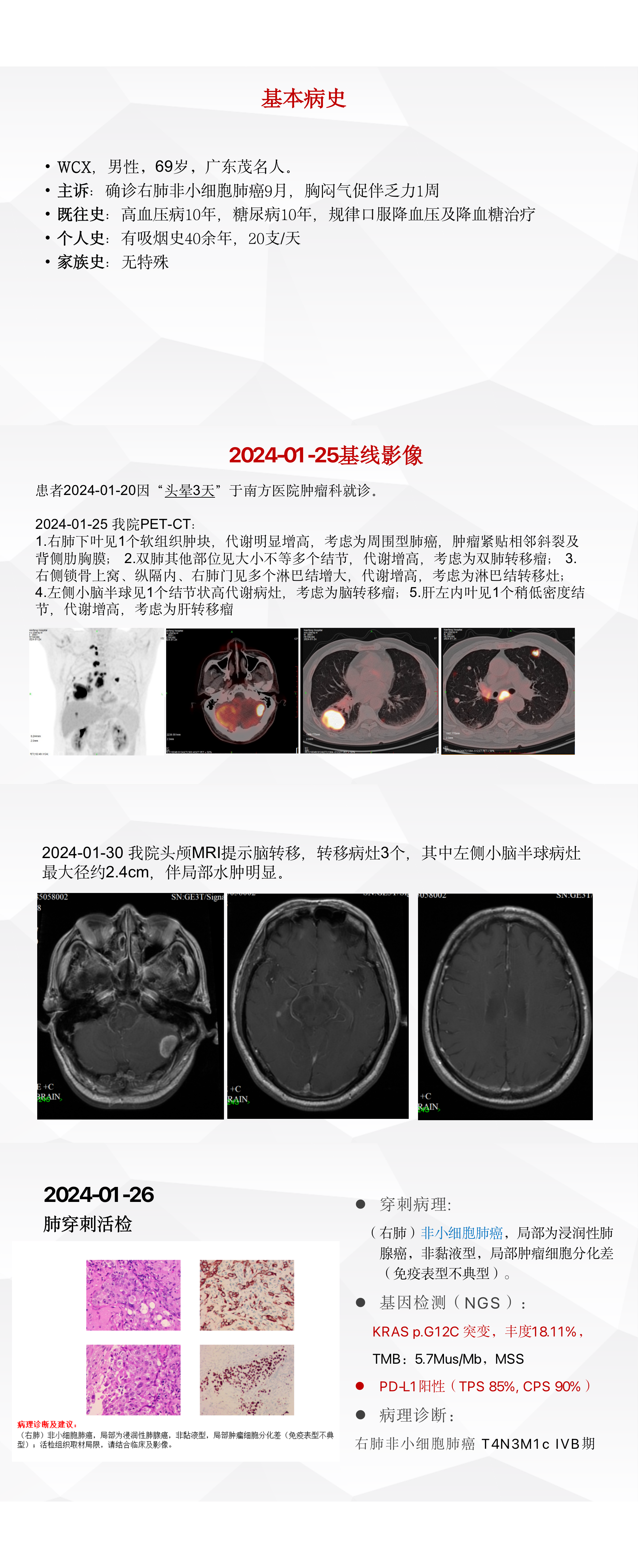 白雪医生病例-广东省医学会肺部肿瘤分会-珠海MDT.png