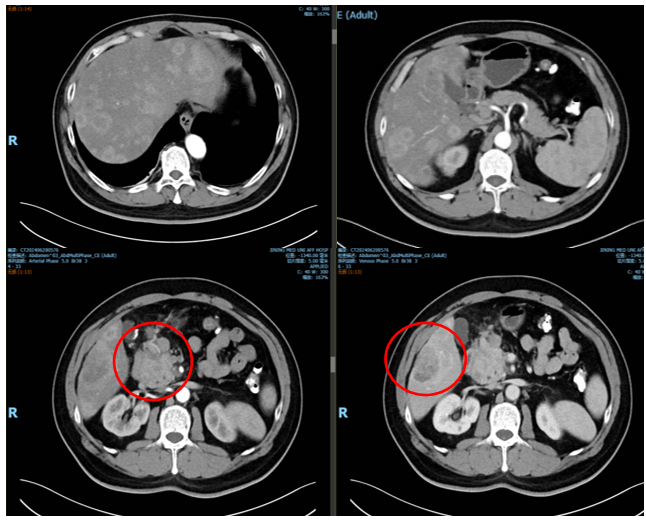 图3. 基线CT(2024年6月20日).png 图3. 基线CT(2024年6月20日).png