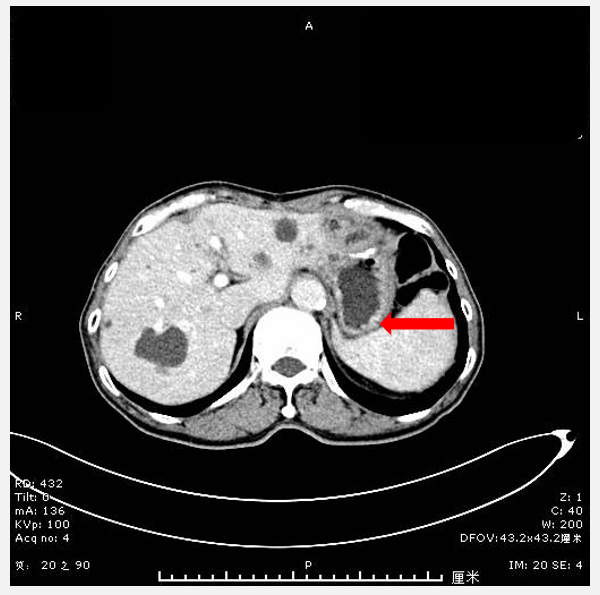 图1. 腹部CT(2024年11月7日).png 图1. 腹部CT(2024年11月7日).png