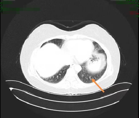 图2. 胸部CT检查(2020年9月17日).png 图2. 胸部CT检查(2020年9月17日).png