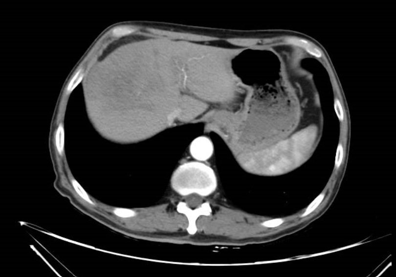 靶免治疗4周期后（2022-08-02）腹部CT影像.png