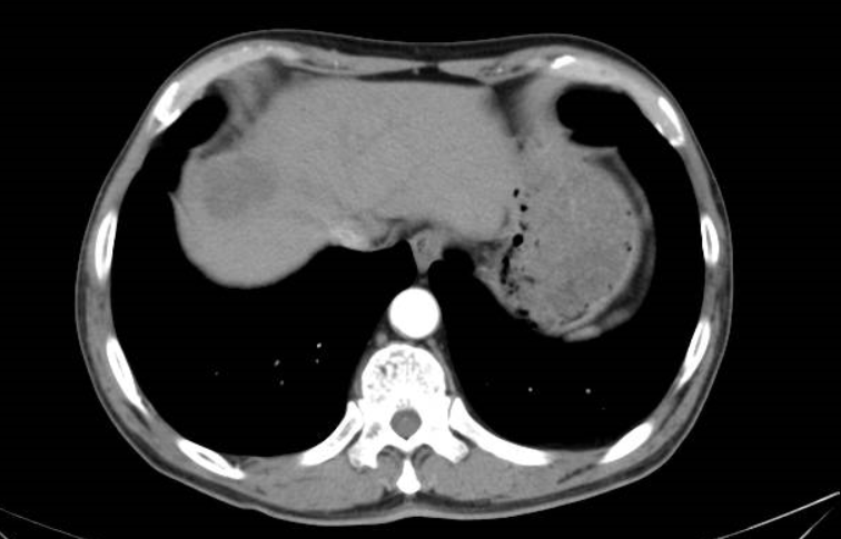 靶免治疗16周期后（2023-04-11）腹部CT影像.png